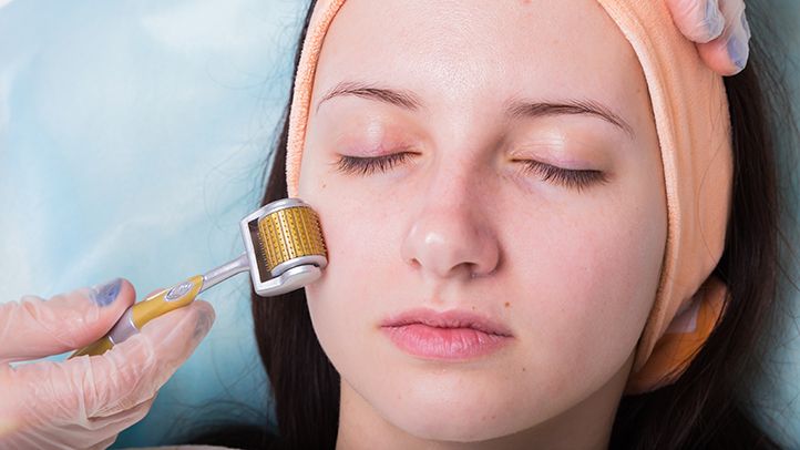 face microneedling